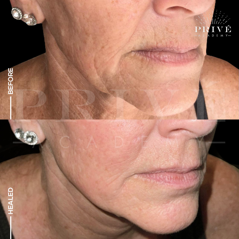 the before and after photos of jaw line, lips and nasolabial lift from fibroblast plasma pen skin tightening treatment