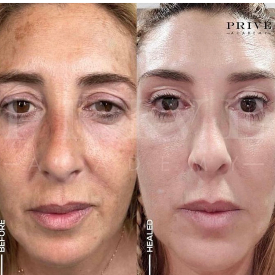 the before and after photos of eyelid lift  and nasolabial lift from fibroblast plasma pen skin tightening treatment