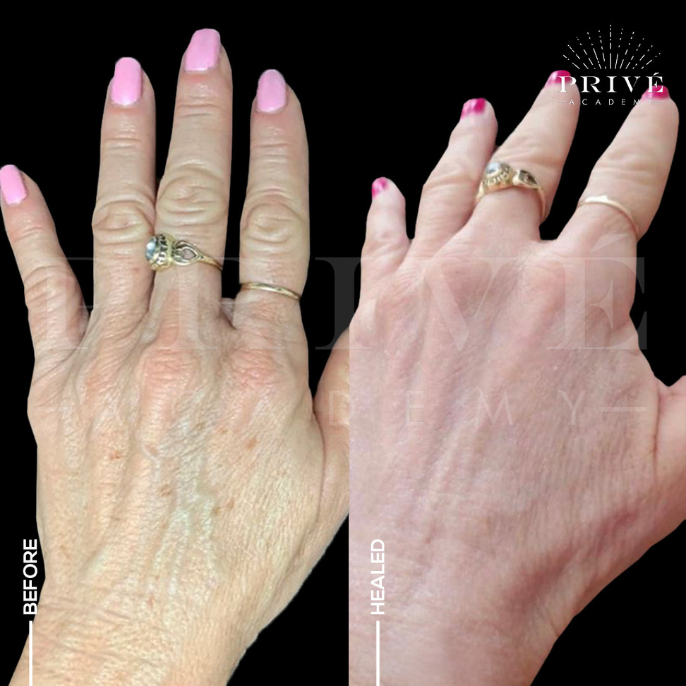 the before and after photos of hand tightening/lift and sun spot removal from fibroblast plasma pen skin tightening treatment