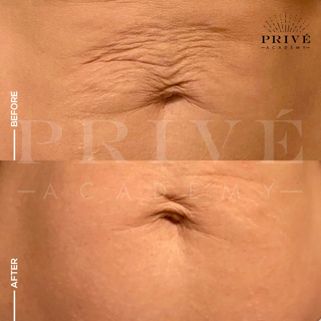 the before and after photos of tummy lift from fibroblast plasma pen skin tightening treatment