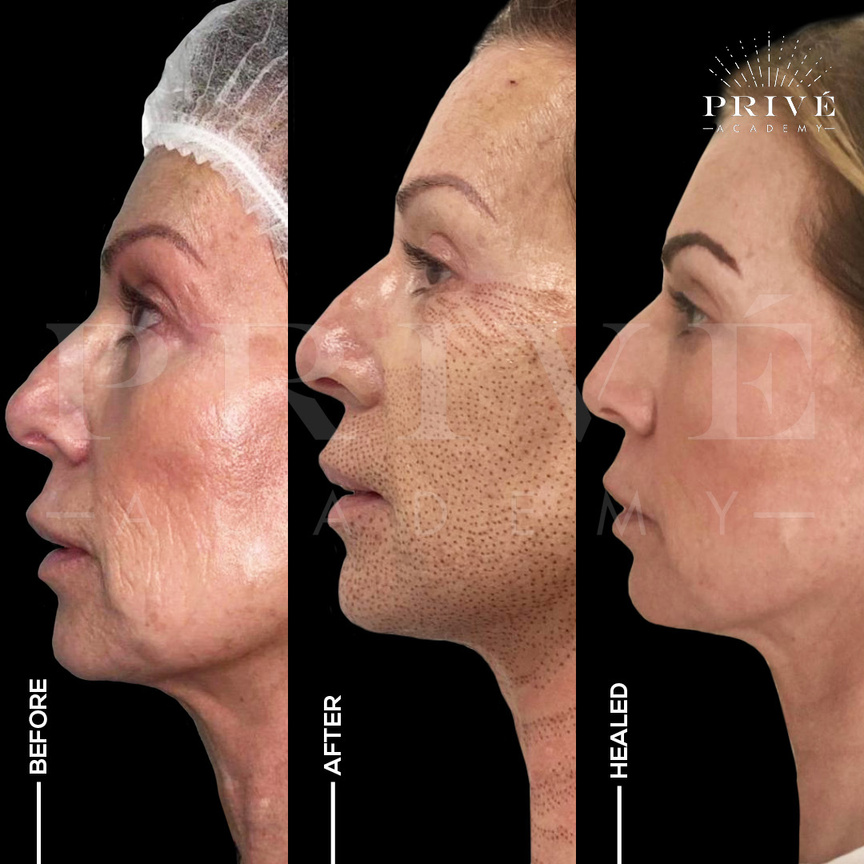 before and after photos of a person's face before and after fibroblast skin tightening, non invasive face lift with plasma pen fibroblast skin tightening