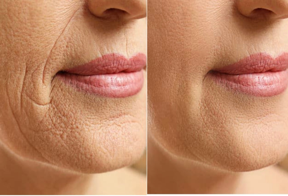 before and after photos of a person with wrinkles on their face before treatment and smooth tight skin after fibroblast skin tightening