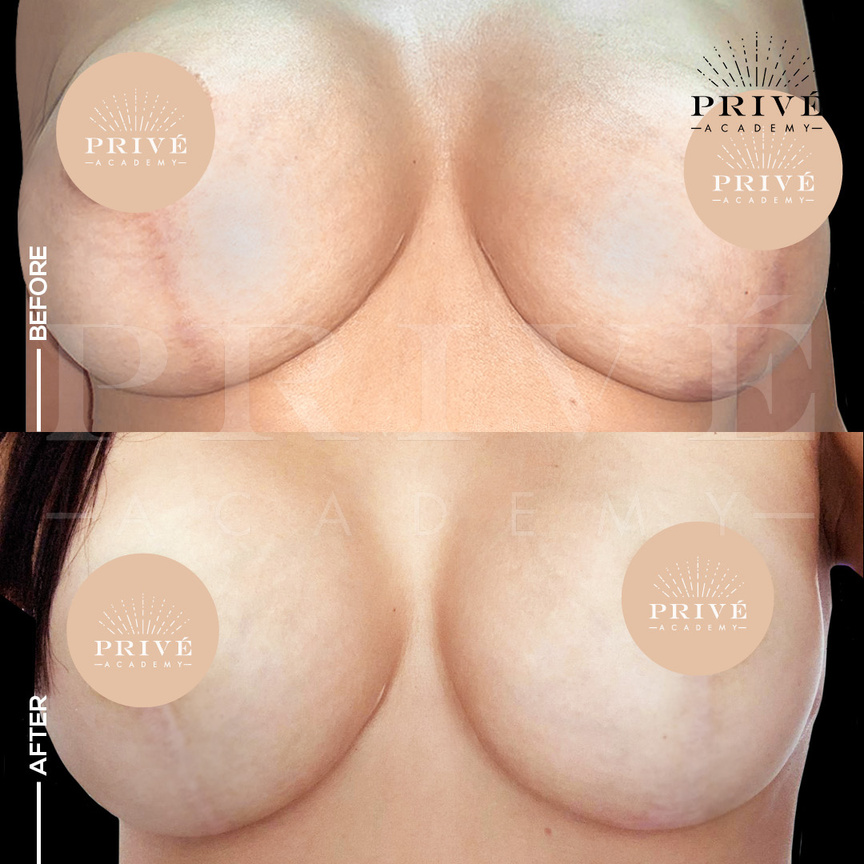 the before and after photos of breast lift from fibroblast plasma pen skin tightening treatment, skin rejuvenation