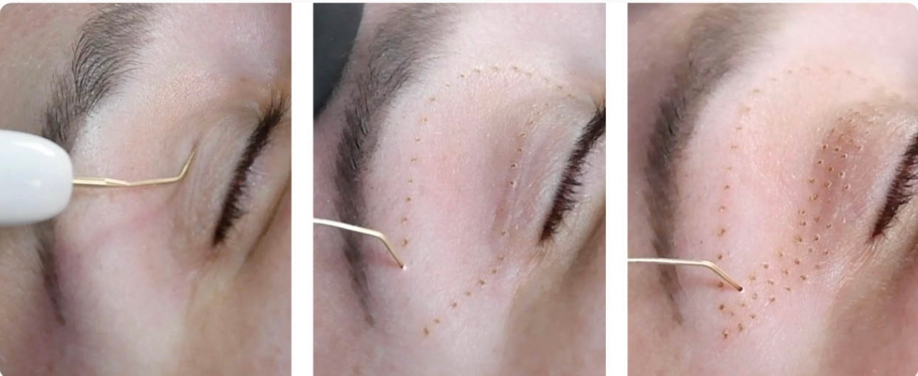 3 pictures showing what fibroblast skin tightening treatment looks like, eyelid lift, full eye lift, eyelid tightening
