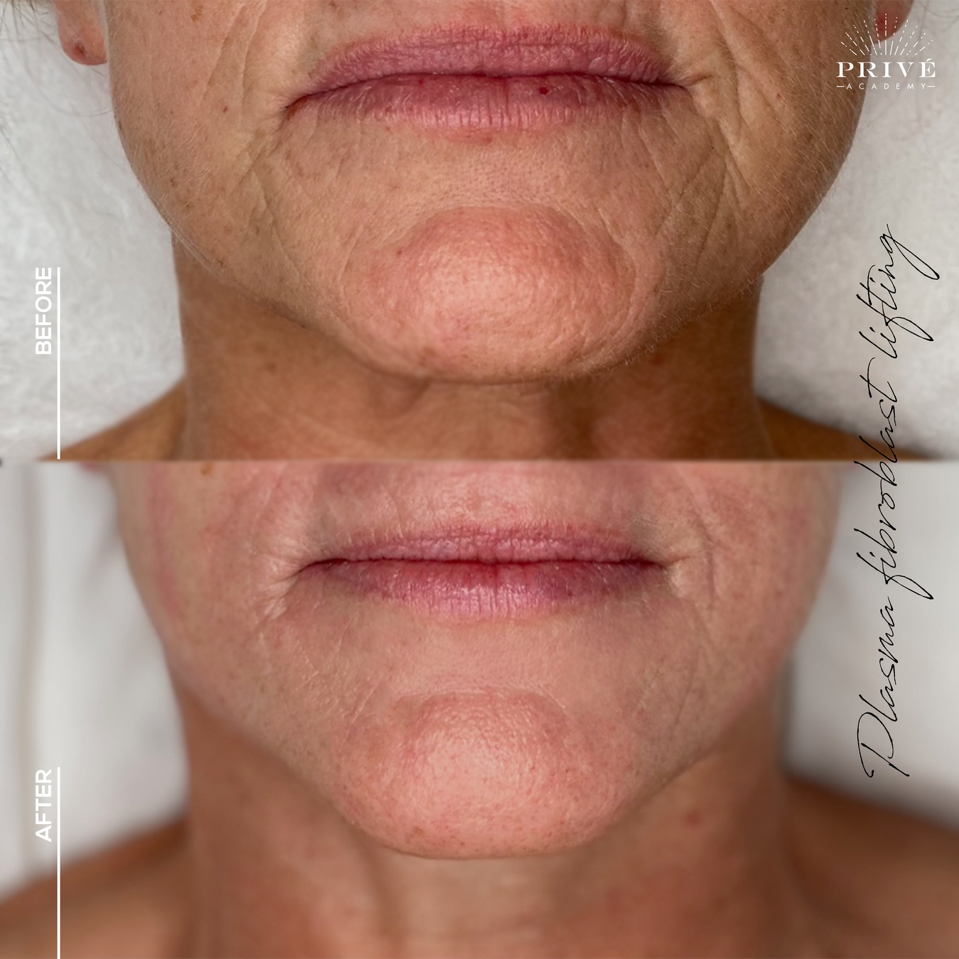 the before and after photos of lower face lift from fibroblast plasma pen skin tightening treatment, half face lift, smooth skin, anti-aging