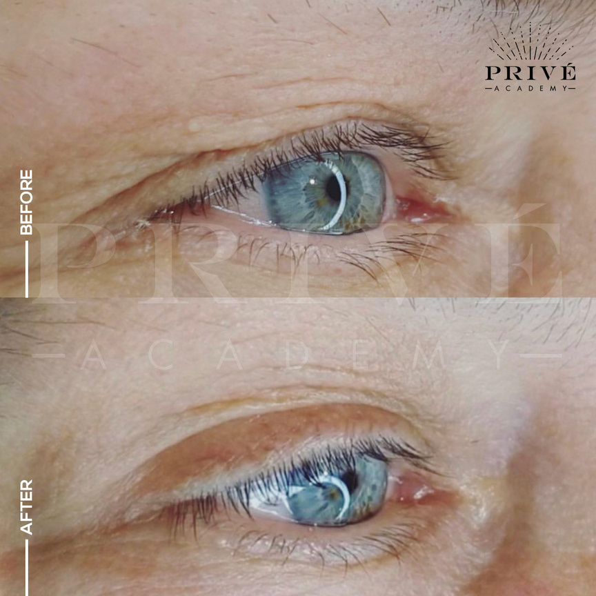 the before and after photos of eyelid lift from fibroblast plasma pen skin tightening treatment, non-invasive, no botox or injections