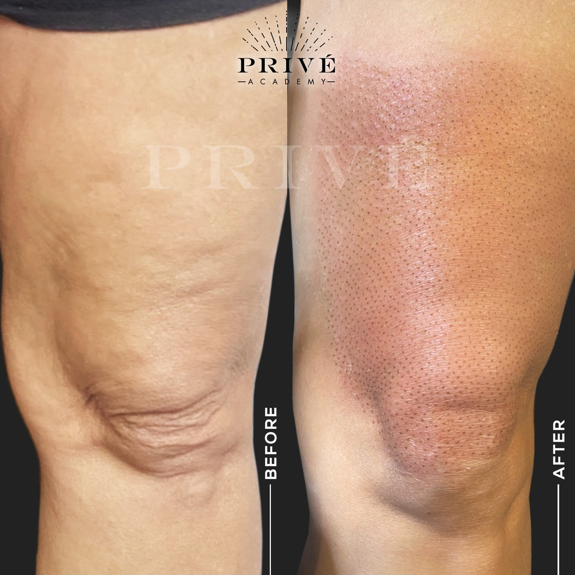 the before and after photos of knee lift from fibroblast plasma pen skin tightening treatment