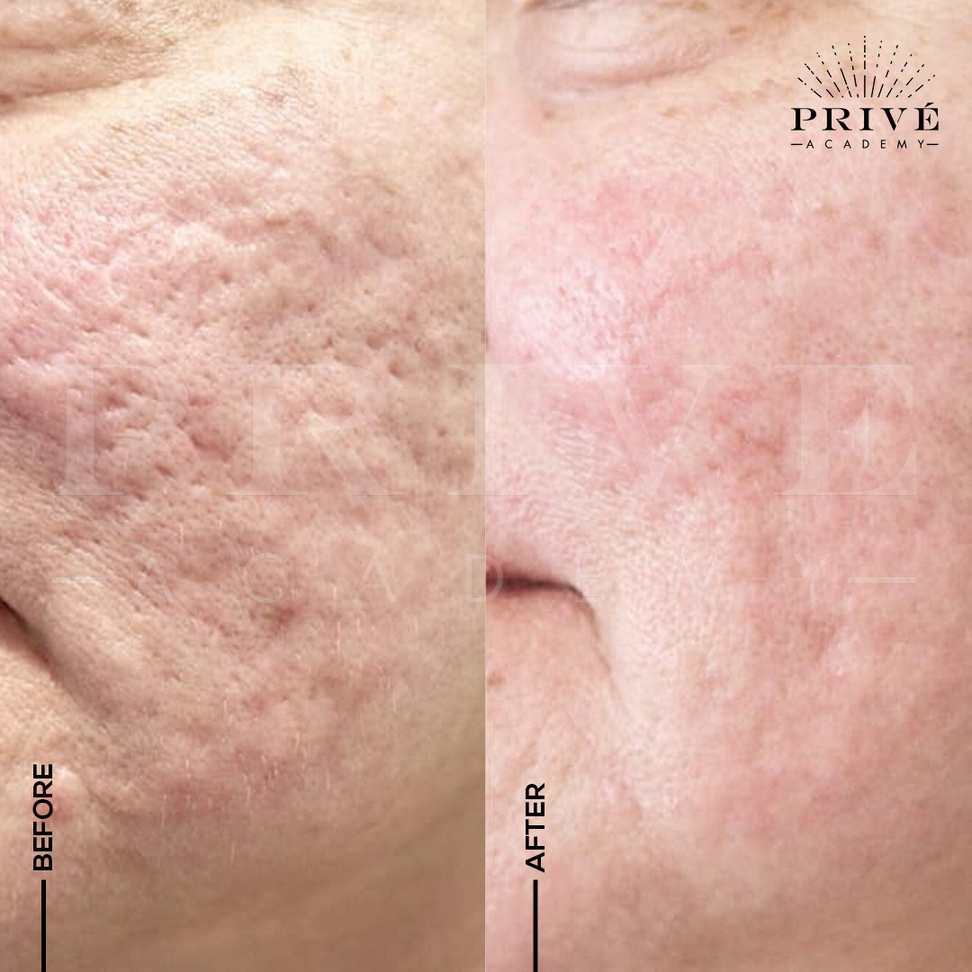 the before and after photos of acne scar treatment from fibroblast plasma pen skin tightening treatment, skin rejuvenation